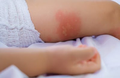 Home Remedies for Diaper Rash