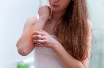 How to Stop Itching Skin in Eczema